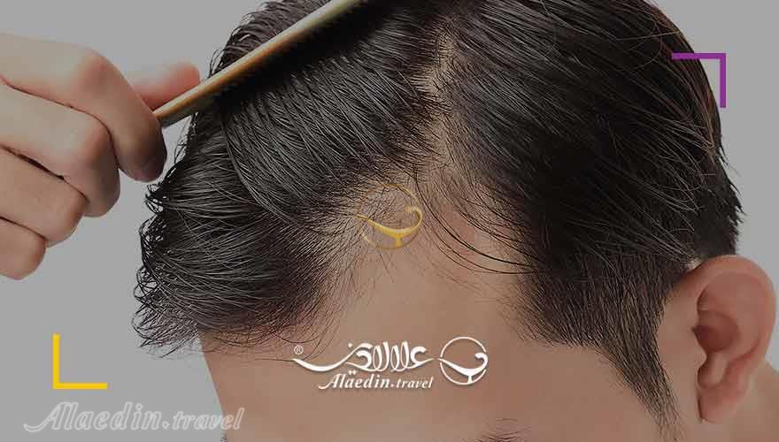 خدمات کاشت مو در ایران